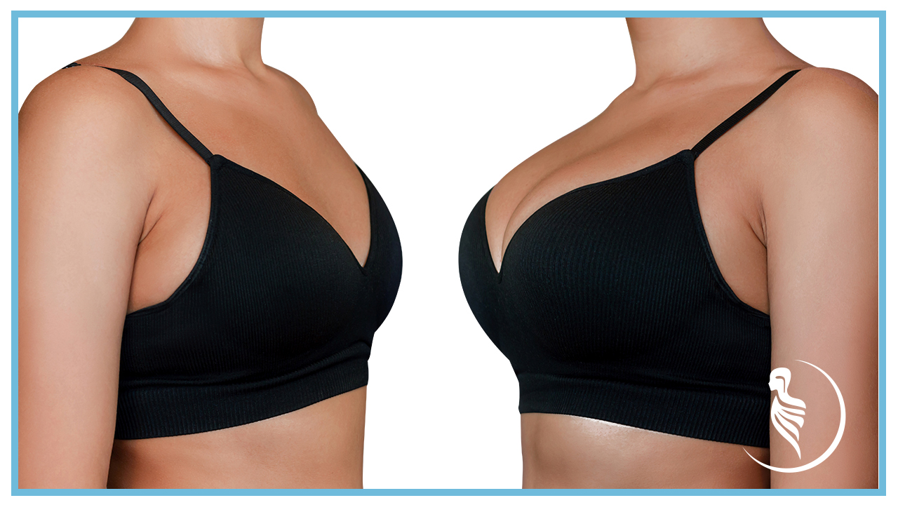 Breast augmentation before breastfeeding